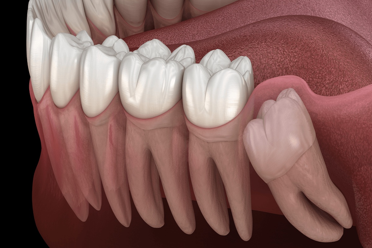 Wisdom Tooth Removal